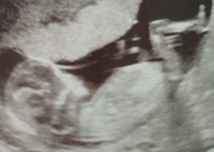 12 Week scan - pregnancy - Our baby